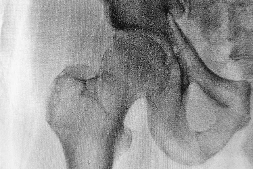 Radiografía de edema óseo